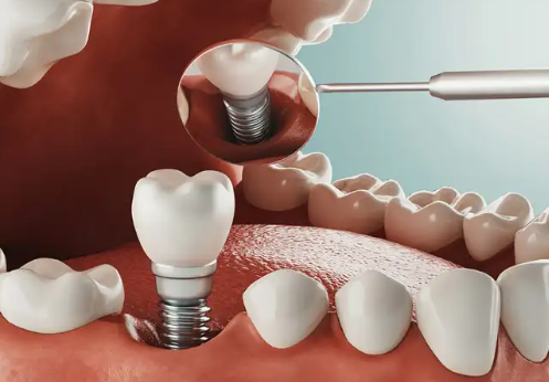 Strategi Efektif untuk Mengelola Biaya Implan Gigi
