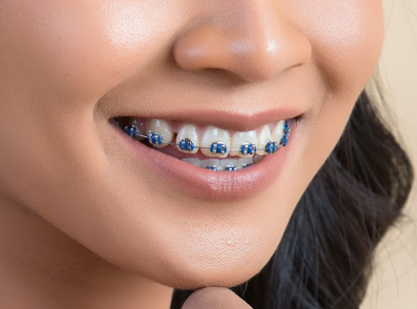 Memilih Warna Behel yang Bagus, Panduan Praktis untuk Senyum Menawan